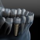 Implantologia dentale
