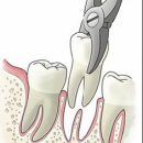 estrazione dei denti